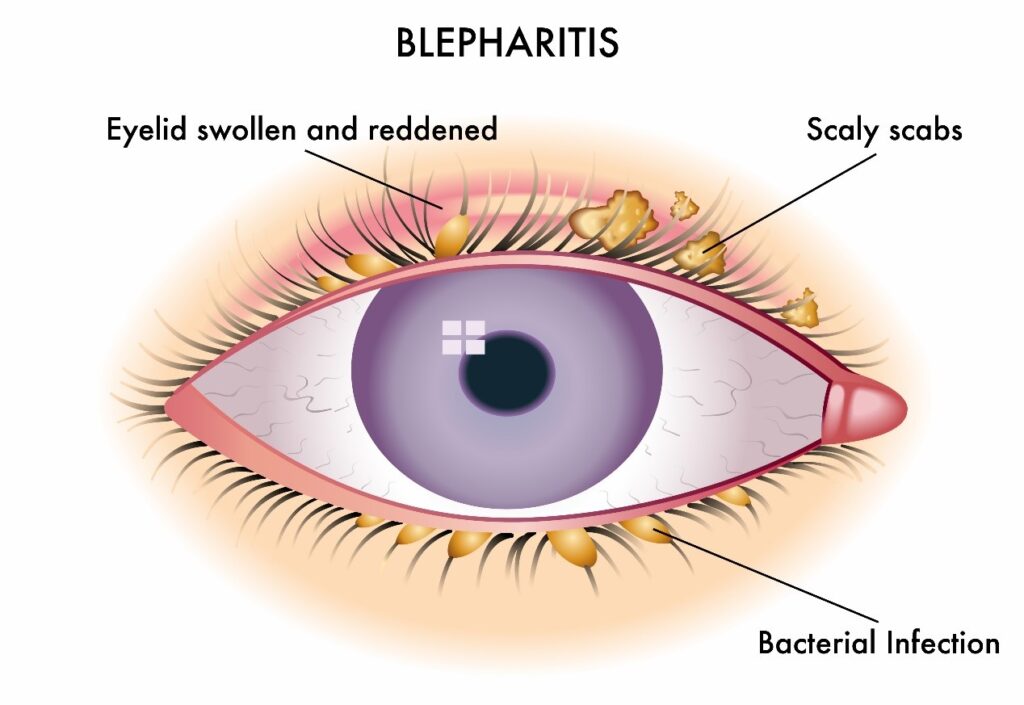 dry eye syndrome blepharitis