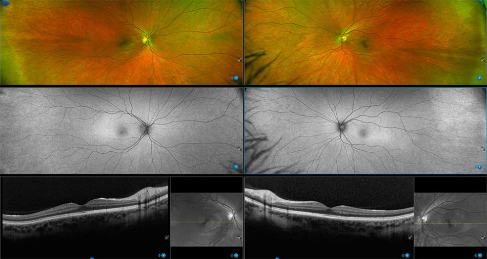 Optos Ultra Wide Field Imaging Scan